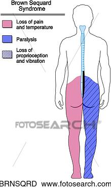brown-sequard-syndrome_~BRNSQRD.jpg